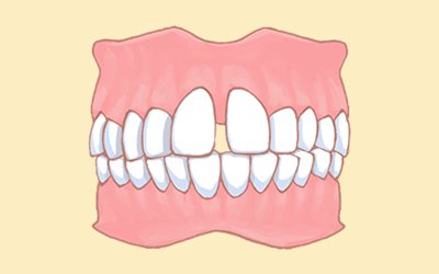 すきっ歯（正中離開）の治療前