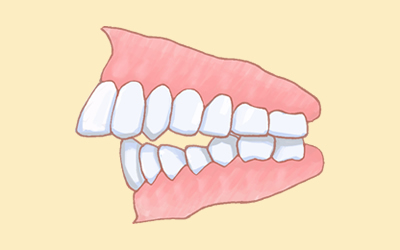 出っ歯（上顎前突）の治療前